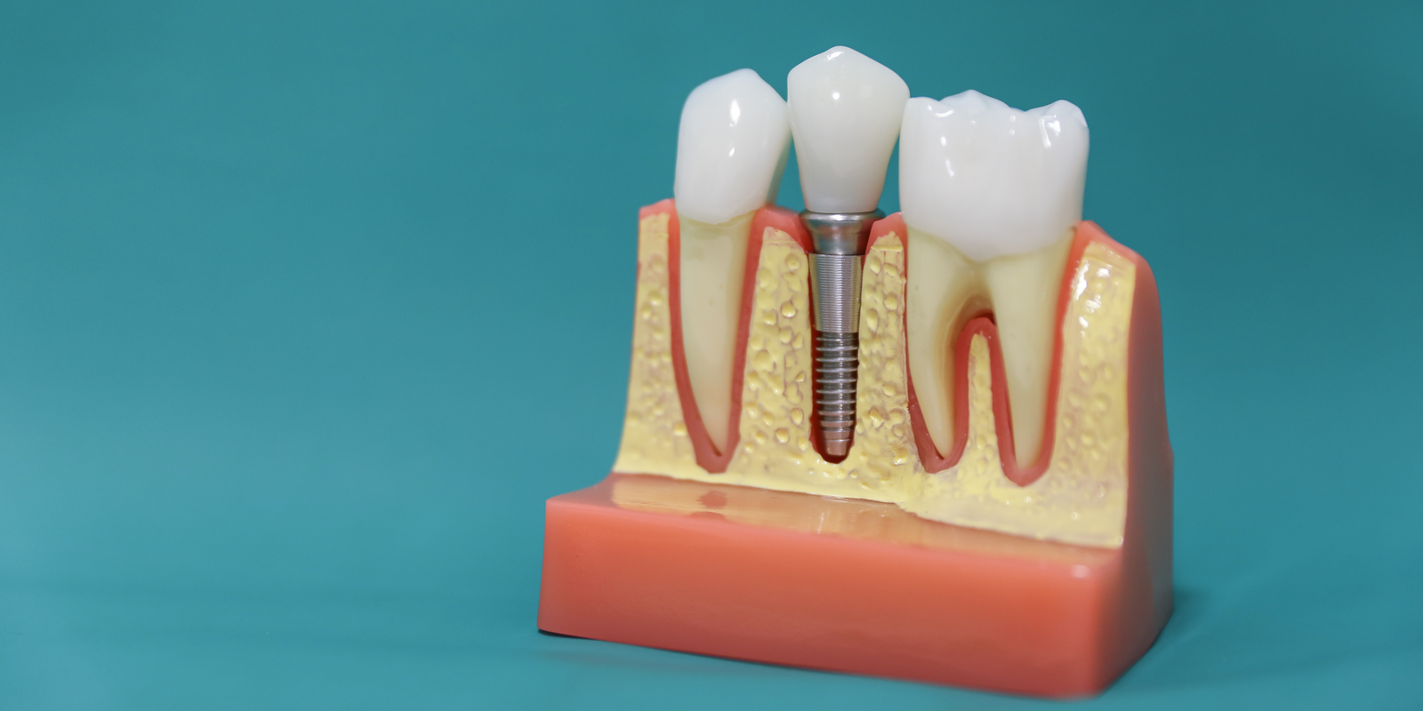 Implantes dentales Costa Rica