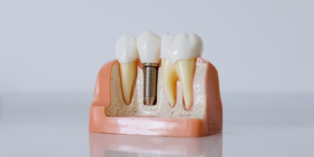 Implantes dentales costa rica